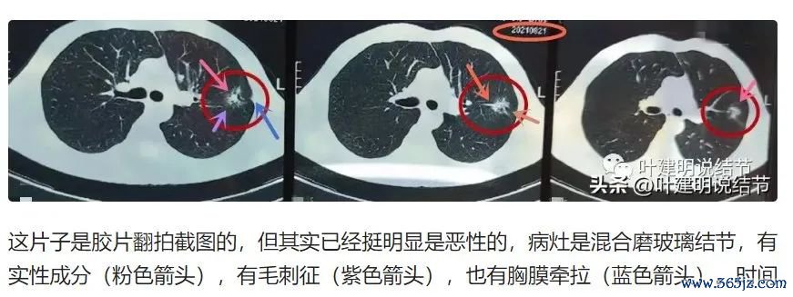 图源:杭州市肿瘤病院胸外科主任叶建明科普著作